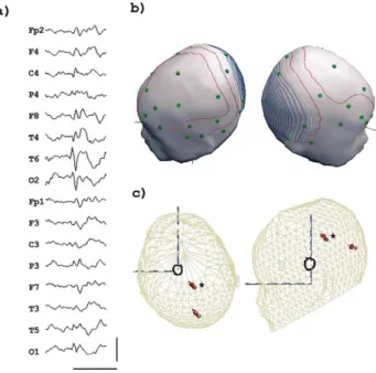 Fig. 7. Patient 4: (a) Raw non-averaged EEG. Horizontal bar: 500 ms;
