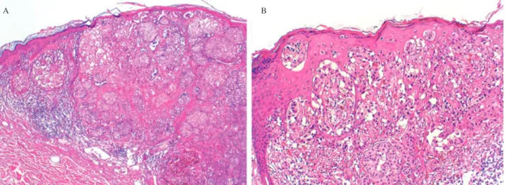 Fig. 2. Histopathology of a pigmented lesion of the thigh that appeared 6 years after the excision of the primary melanoma