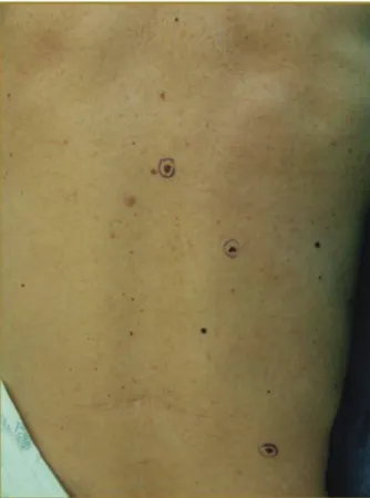 Fig. 3. The clinical appearance of several pigmented lesions on the back is depicted.