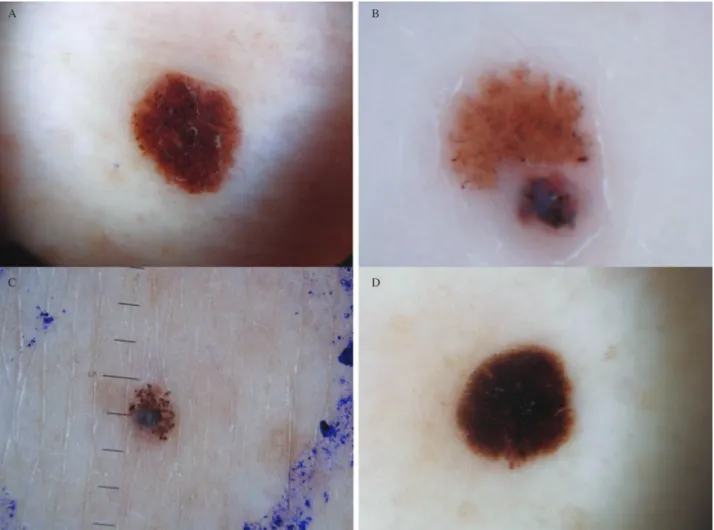 Fig. 6. Heterogeneous clinical and dermoscopic findings are depicted. There is a uniform diffuse brown lesion with a few darker dots throughout and at its periphery (A)