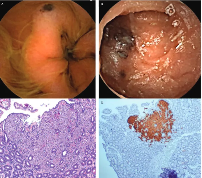 Fig. 7. Gastrointestinal melanoma metastases are depicted. The endoscopic appearance of gastrointestinal lesions shows dark-brown macules and ulcerated nodules