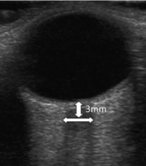 Fig. 1 Optic nerve sonography. The optic nerve complex is shown as a sharply-defined hypoechoic stripe in between the echogenic retrobulbar fat