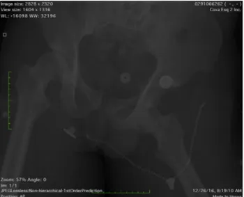 Fig 1. Pelvis radiograph showing the anteroinferior left hip dislocation and the contralateral wing of ilium fracture.
