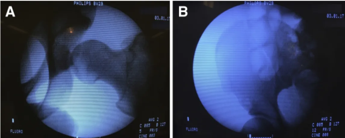 Fig 4. Preoperative ﬂuoroscopy during traction test of the left hip (A). No fracture deviation was shown (B).