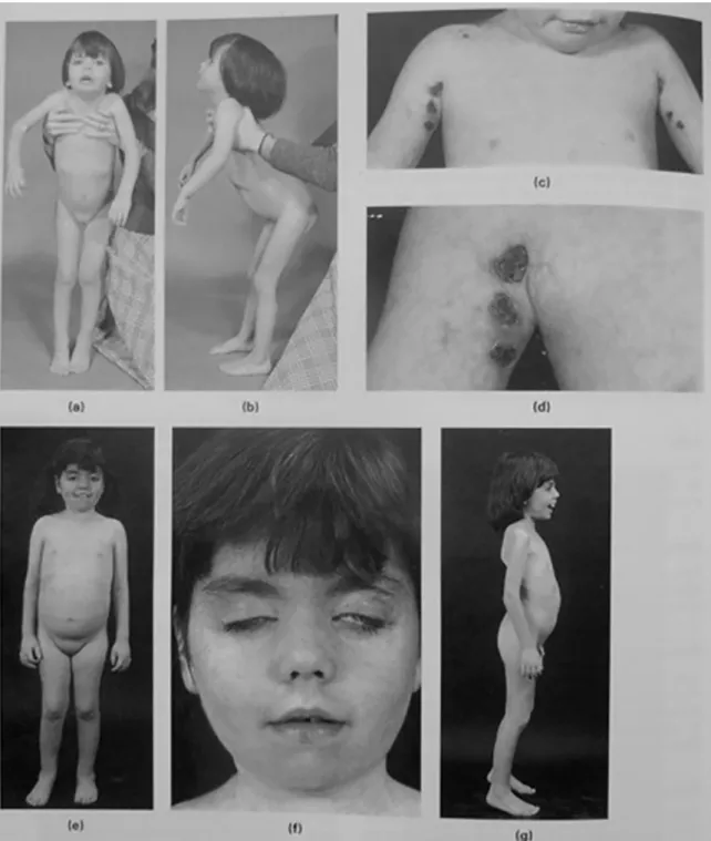 Fig. 1. Dermatomyositis; vasculitic ulcers; recurrent contractures. This girl was first seen at 3 years of age with an 8-month history of weakness, skin rash and misery, with progressive flexion contractures of the hips (a) and knees (b)