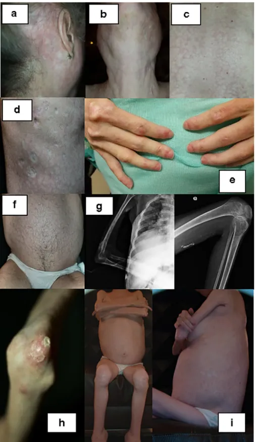 Fig. 2. Clinical features of the patient as an adult: poikiloderma and skin tightness (a); parotid hypertrophy (b); livedo reticularis over dorsum (c); atrophic scars (d); periungueal telangiectasia (e); hirsutism (f); calcinosis in fascial planes and join