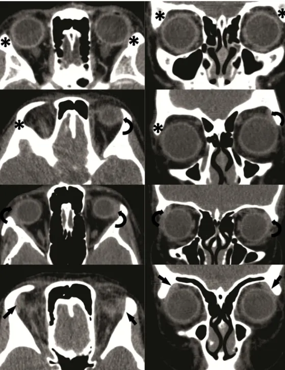 Figure 2. From top to bottom: axial (left) and coronal (right) computed tomography (CT) scans of 4 distinct patients
