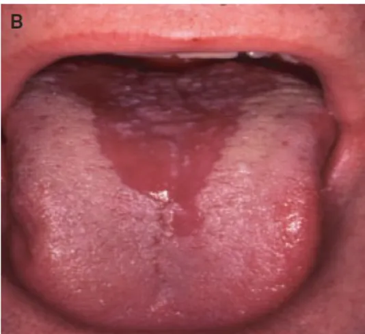 Figura 11: Candidíase eritematosa aguda  (retirado de Williams, 2010)                                         