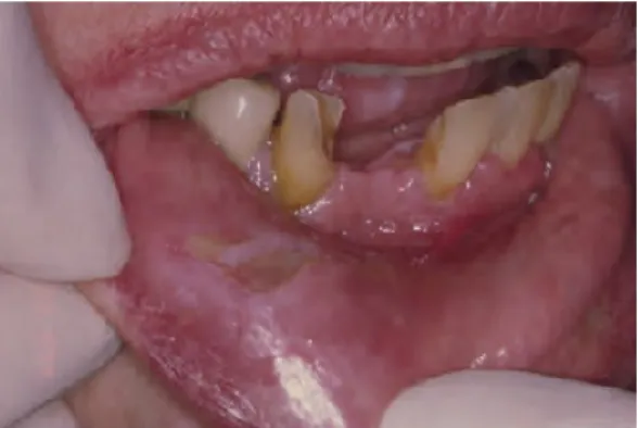 Figura 15: Úlcera traumática causada por trauma dentário                                         (retirado de Glick, 2015) 