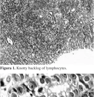 Figura 1. Knotty backlog of lymphocytes.