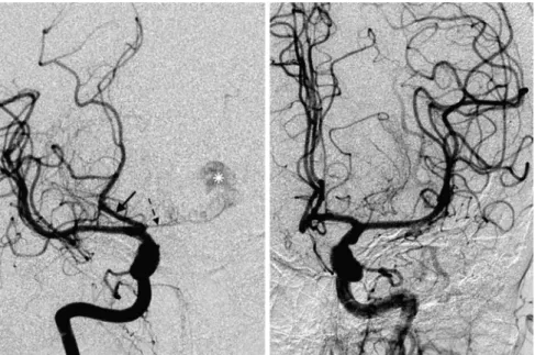 Figure 3 Bilateral partial fetal-type posterior cerebral artery (fPCA). Anteroposterior projections after contrast injection on the right (A) and left (B) internal carotid artery depict opaci ﬁ cation of the anterior circulation and PCA bilaterally, via po