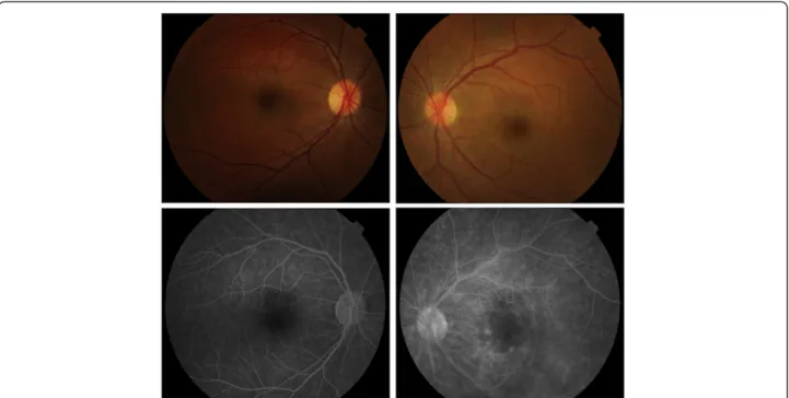 Figure 1 Baseline retinography and fundus fluorescein angiography. Right eye retinography (top left) reveals no pathologic alterations