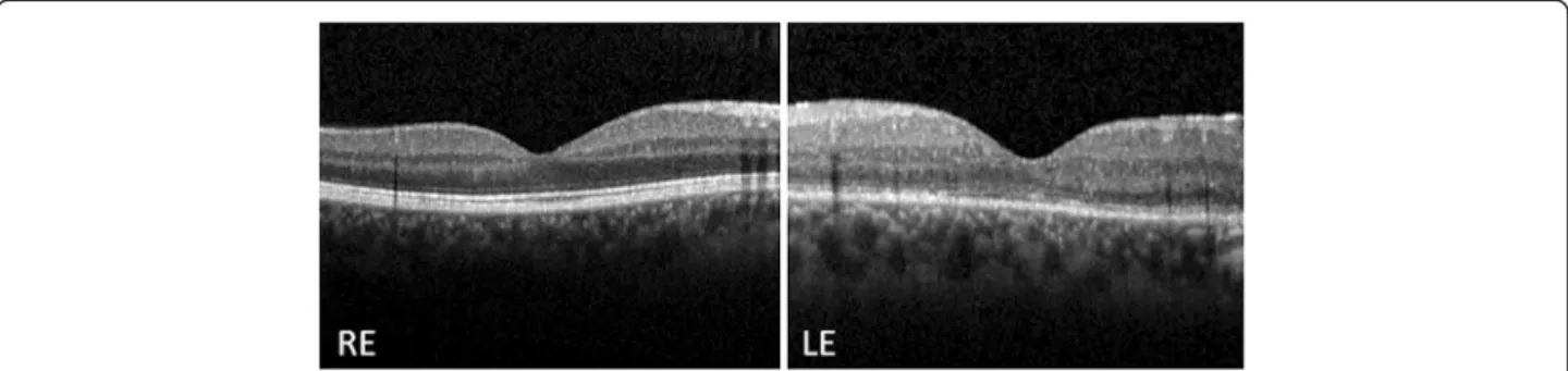 Figure 5 Macular spectral domain optical coherence tomography following intravitreal dexamethasone implant 0.7mg and laser panretinal photocoagulation in the left eye
