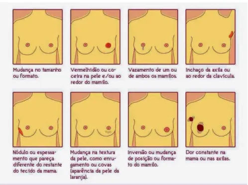 Figura 2 – Sinais e sintomas do cancro da mama 