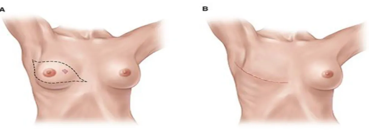 Figura 3 – Mastectomia total 