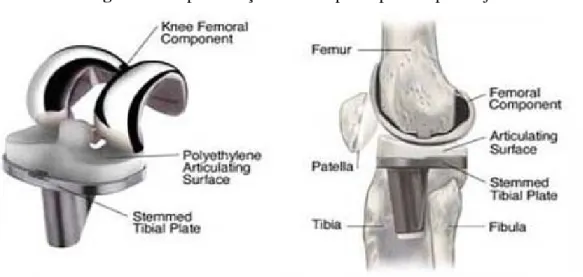 Figura 2 - Representação de um tipo de prótese para o joelho. 