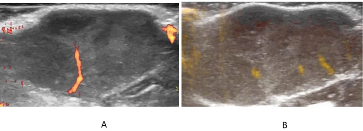 Figura  7.  Imagens  ultrassonográficas das lesões mamárias  identificadas  por  palpação  no  grupo MNU  sedentário, avaliadas pelo modo Power Doppler (A) e pelo modo B Flow (B)