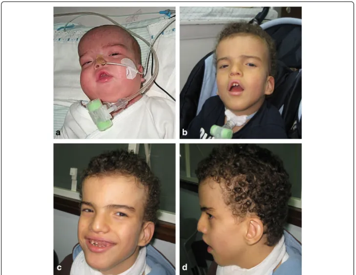 Fig. 1 Clinical facial features of the patient at different ages. a At 5th months: facial edema, short nose with wide and depressed root; b At 4-year-old: turricephaly, curly hair, straight eyebrows with synophrys, opened tented mouth; c and d At 10-year-o