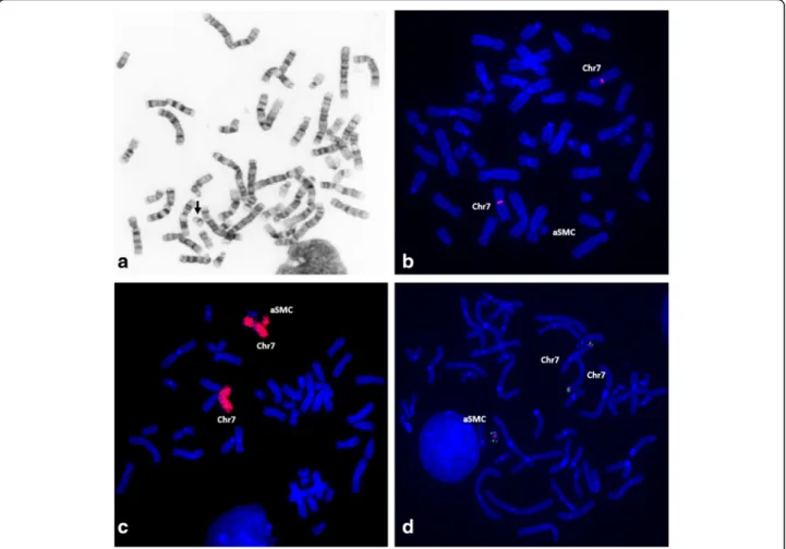 Fig. 2 Cytogenetic and FISH investigation a GTL-banded chromosomes showing the aSMC (arrow); FISH with b α -satellite probe for chromosome 7 showing absence of signal on the aSMC; c WCP(7) showing the presence of chromosome 7 euchromatin in the aSMC; d BAC