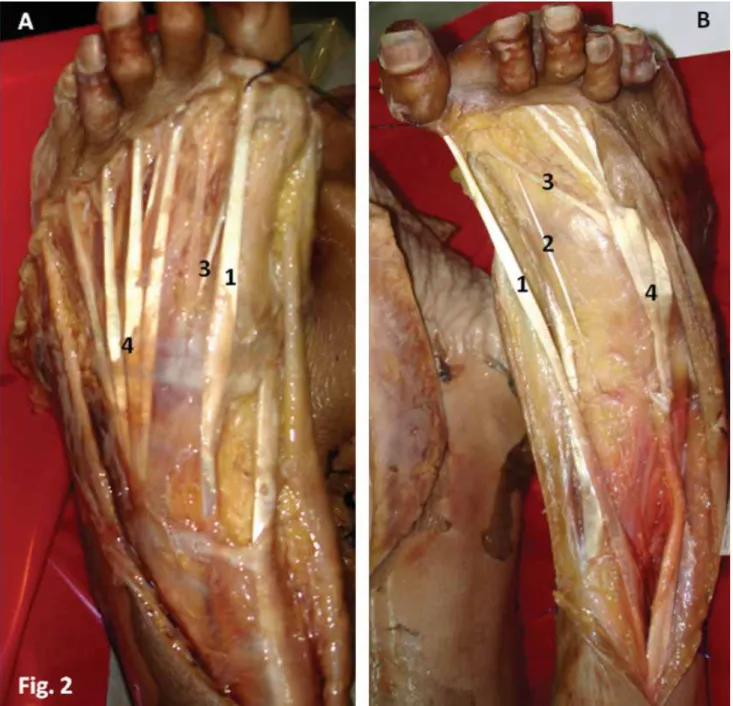 Figure 2. Dorsal view of the left (A) and right (B) feet of two different cadavers, showing anatomical variations in the extensor tendons of the hallux