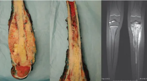 Figura 8: Osteossarcoma desenvolvido nos ossos da perna (Adaptado de Niederhuber, 2014)