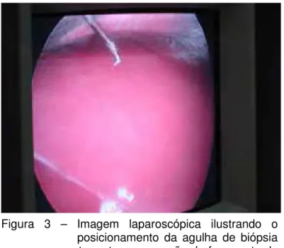 Figura 3 – Imagem laparoscópica ilustrando o posicionamento da agulha de biópsia tru-cut para remoção de fragmento do lobo hepático direito.