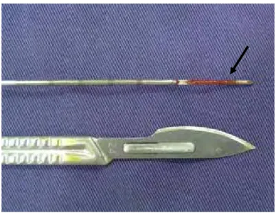 Figura 4 – Imagem fotográfica ilustrando o fragmento hepático (seta) obtido com agulha tru-cut.