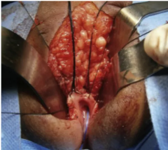 Fig. 10. Posterior sagittal anorectoplasty. Presence of an endoluminal septum e tubular rectal duplication.