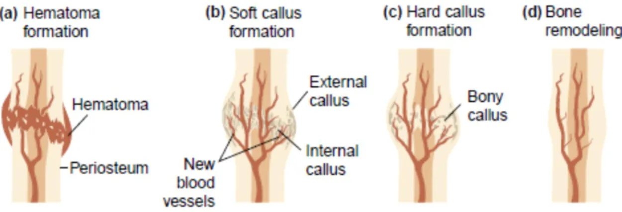 Figure 2.8 - Schematic representation of the four stages of bone fracture repair  (45)