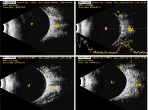 Figura  3.  As  fotos  correspondem  à  janela  acústica  obtida  durante  a  realização  do  bloqueio  peribulbar  guiado  por  ultrassom,  contendo  o  bulbo  (B),  o  cone  muscular  (CM) e a agulha