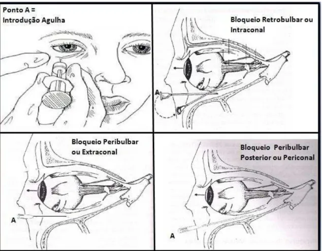 Figura  5  –  Bloqueios  Oftalmológicos:  posicionamento  da  agulha  em  relação  às  estruturas  contidas no globo ocular