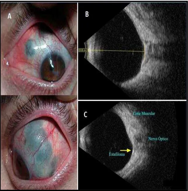 Figura 8 - Paciente alto míope: A= esclera delgada + estafiloma (deformidade do globo ocular),  B e C = comprimento axial maior que 26 mm (C.A