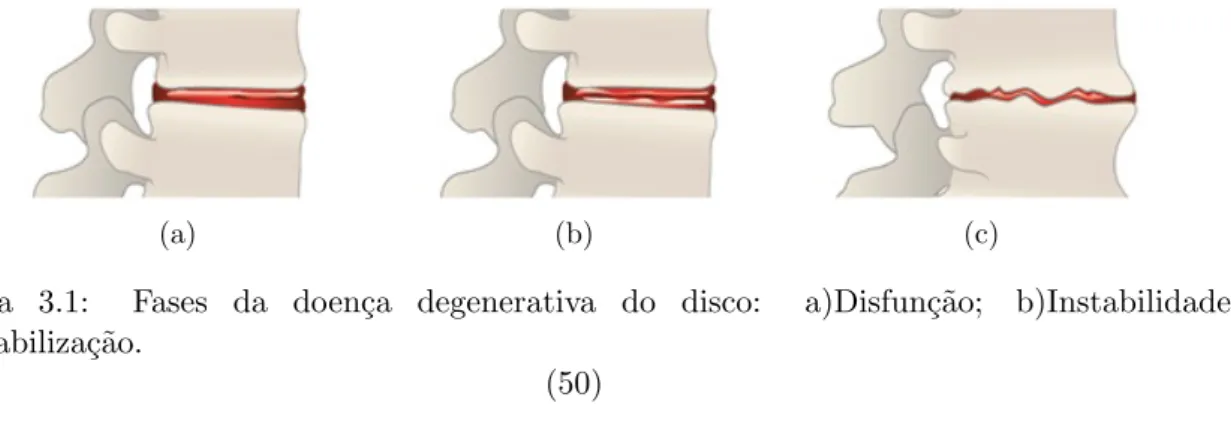 Figura 3.1: Fases da doen¸ ca degenerativa do disco: a)Disfun¸ c˜ ao; b)Instabilidade;