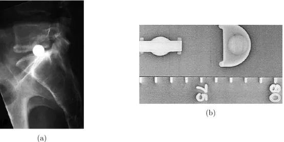 Figura 3.11: a)Bolas de A¸ co desenvolvida por Fernstrom; b)Implante desenvolvido por Fassio (73)