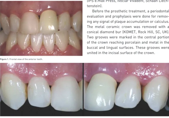 Figure 1. Frontal view of the anterior teeth.