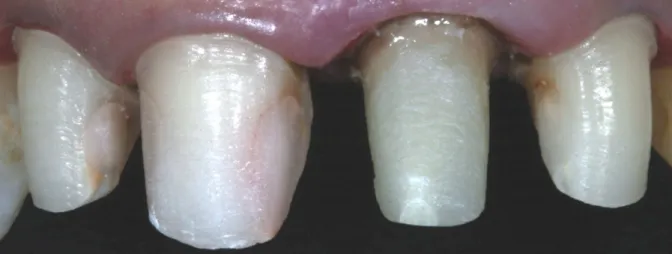Figure 6. Aspect of the finished mold with a well defined and uniformity margin. Figure 7
