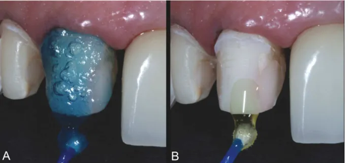 Figure 10. Hybridization of dental hard tissues; A. Phosphoric acid etching for 15 seconds; B