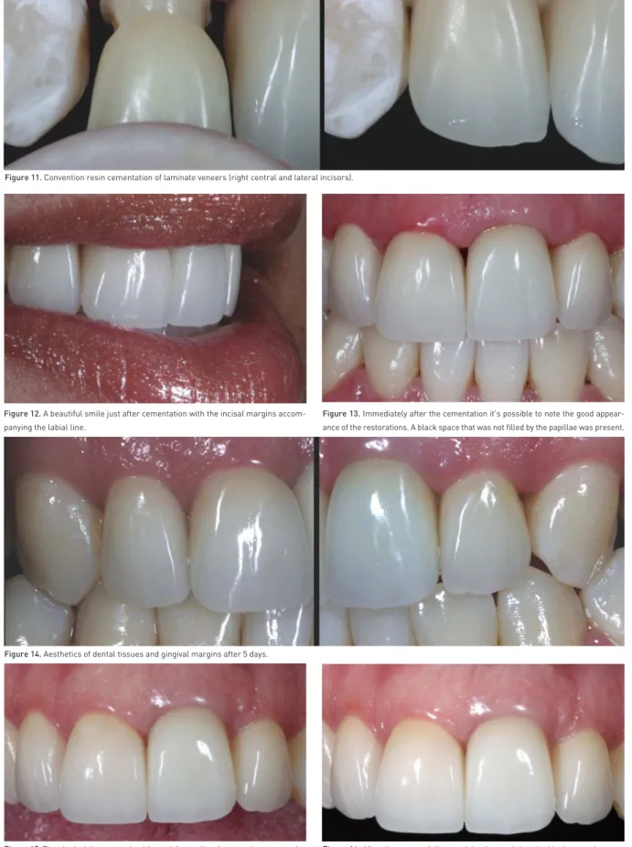 Figure 12. A beautiful smile just after cementation with the incisal margins accom- accom-panying the labial line.