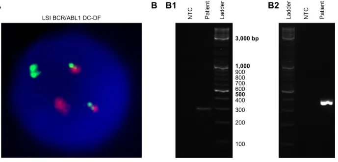 Figure 2 Cytogenetic (A) and molecular (B) analyses of ph+ aLL patient’s bone marrow sample.