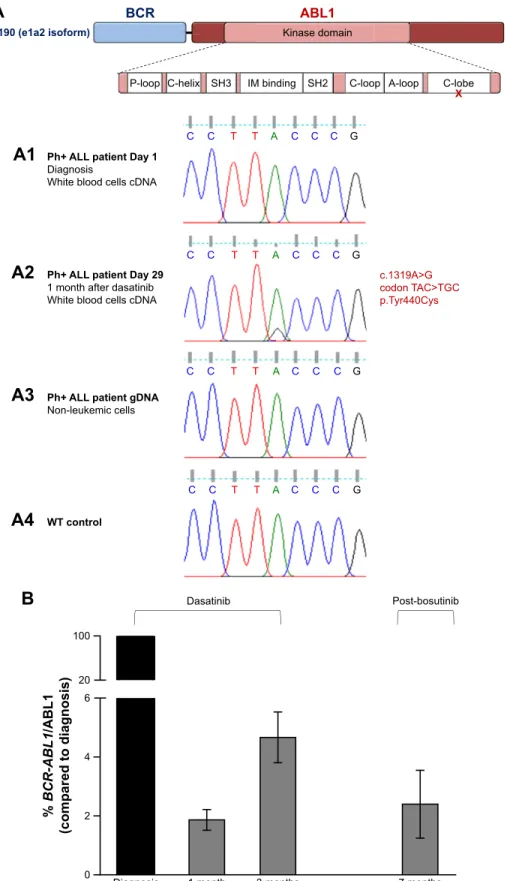Figure 3 ph+ aLL patient’s novel BCr-aBL1 point mutation and disease molecular monitoring.