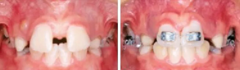 Figura 5: Encerramento do diastema com ortodontia fixa. (Adaptado de: Almeida et al., 2004)