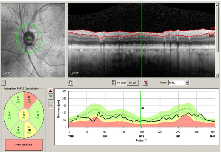 Fig. 1 Thickness of retinal nerve fiber layer obtained by B RNFL Single Exam Report OU with FoDi ™^ (Spectralis Heidelberg; μ m).