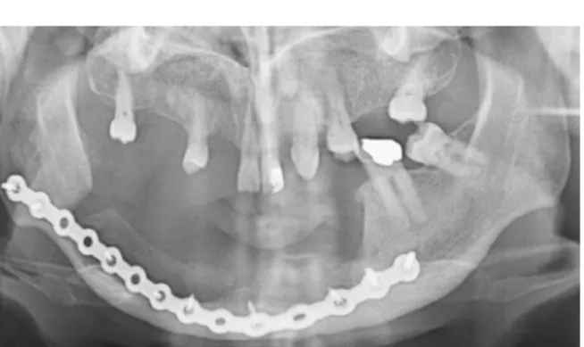 Figura 14 – Ortopantomograﬁa 6 meses após reconstruc¸ão da mandíbula com enxertos corticoesponjosos colhidos de ambas as cristas ilíacas anteriores.