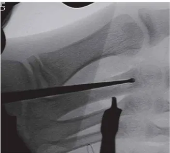 Figura 1. Radiografia perfil pé direito: início dos sintomas, onde se identifica lesão osteolítica de limites esclerosantes metáfise proximal 2º metatársico.
