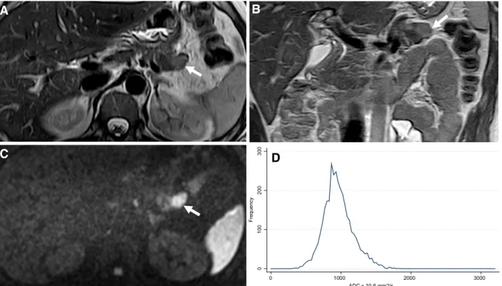 Fig. 2. Magnetic resonance images of a G2 PanNET from a 29-year-old female patient. Axial (A) and coronal (B) T2 weighted show a slight hyperintense exophytic lesion (arrow)