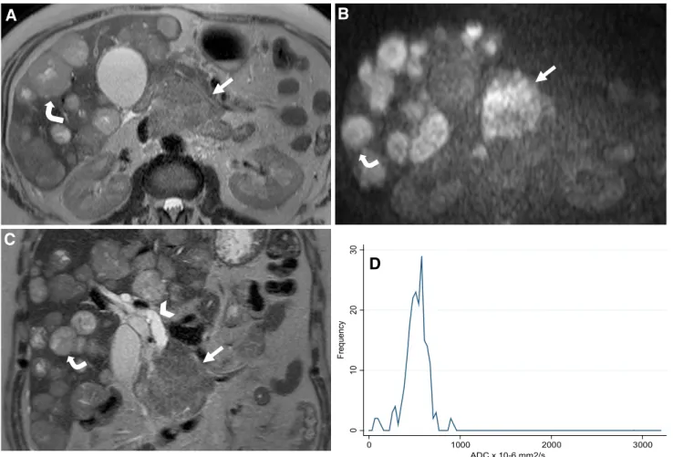 Fig. 3. Magnetic resonance images of a G3 PanNET from a 45-year-old male patient. Axial T2 weighted A shows a large heterogeneous hyperintense lesion (arrow) in the head,  isth-mus, and body of the pancreas