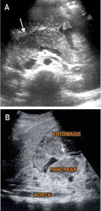 Fig. 1A – Área hipoecogénica no corpo do pâncreas (seta);