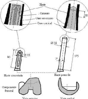 Figura 5 - Sistemas de fixação mecânica do fémur  intacto (esquerda) e com implante (direita) na zona 