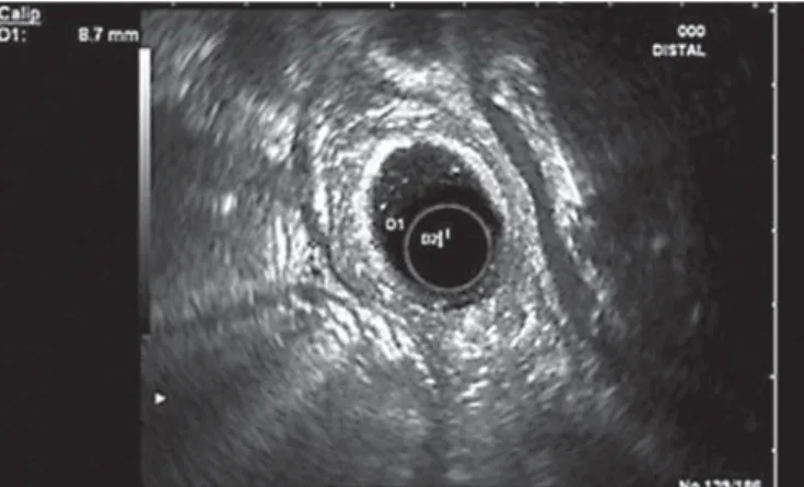 Fig. 3.   EUS showing hypoechoic thickening of the D2 wall.           Fig. 4.   EUS showing a circumferentially thickened duodenal wall