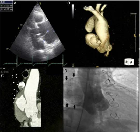 Figure 1 Imaging of ascending aortic pseudoaneurysm. (A) Transthoracic echocardiography showing ascending aortic pseudo- pseudo-aneurysm in parasternal view; (B) three-dimensional computed tomography (CT) reconstruction of aorta; (C) CT scan with  intra-ve